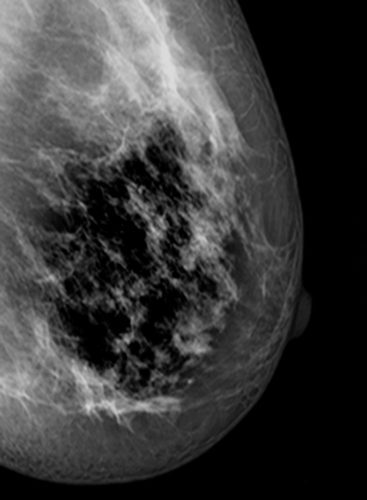 collection of Mammogram radio imaging for breast cancer